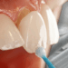 A close up of a dental veneer is seen being applied to a tooth, presumably in a Turkey teeth-esque setting.