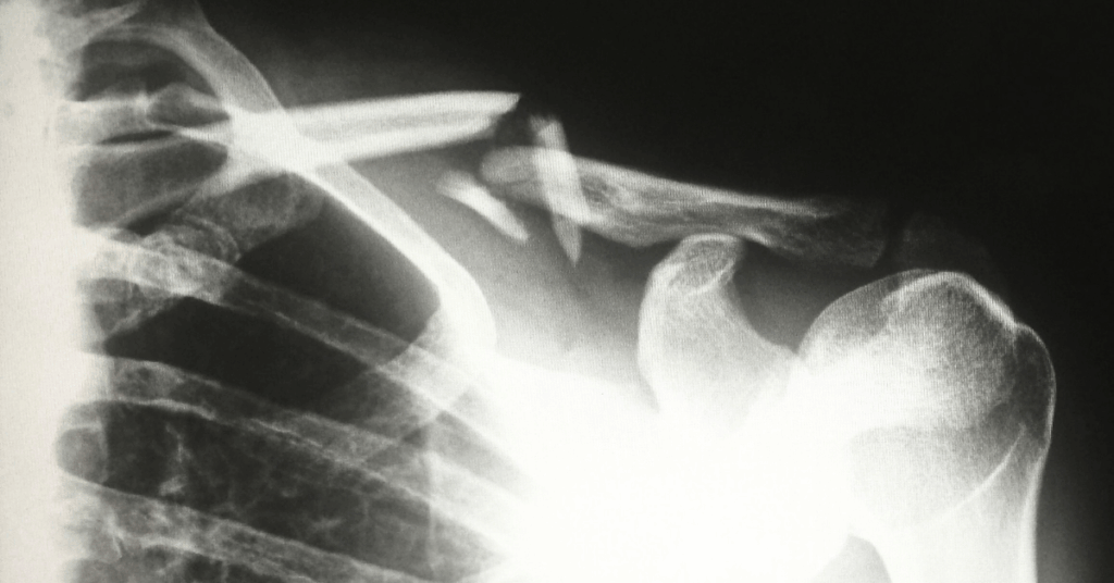 A close up of an X Ray is seen, showing a clear break in the collarbone or shoulder joint of a patient. The pain is, presumably, unimaginable. The victim needs Personal Injury representation from Pabla & Pabla Solicitors.
