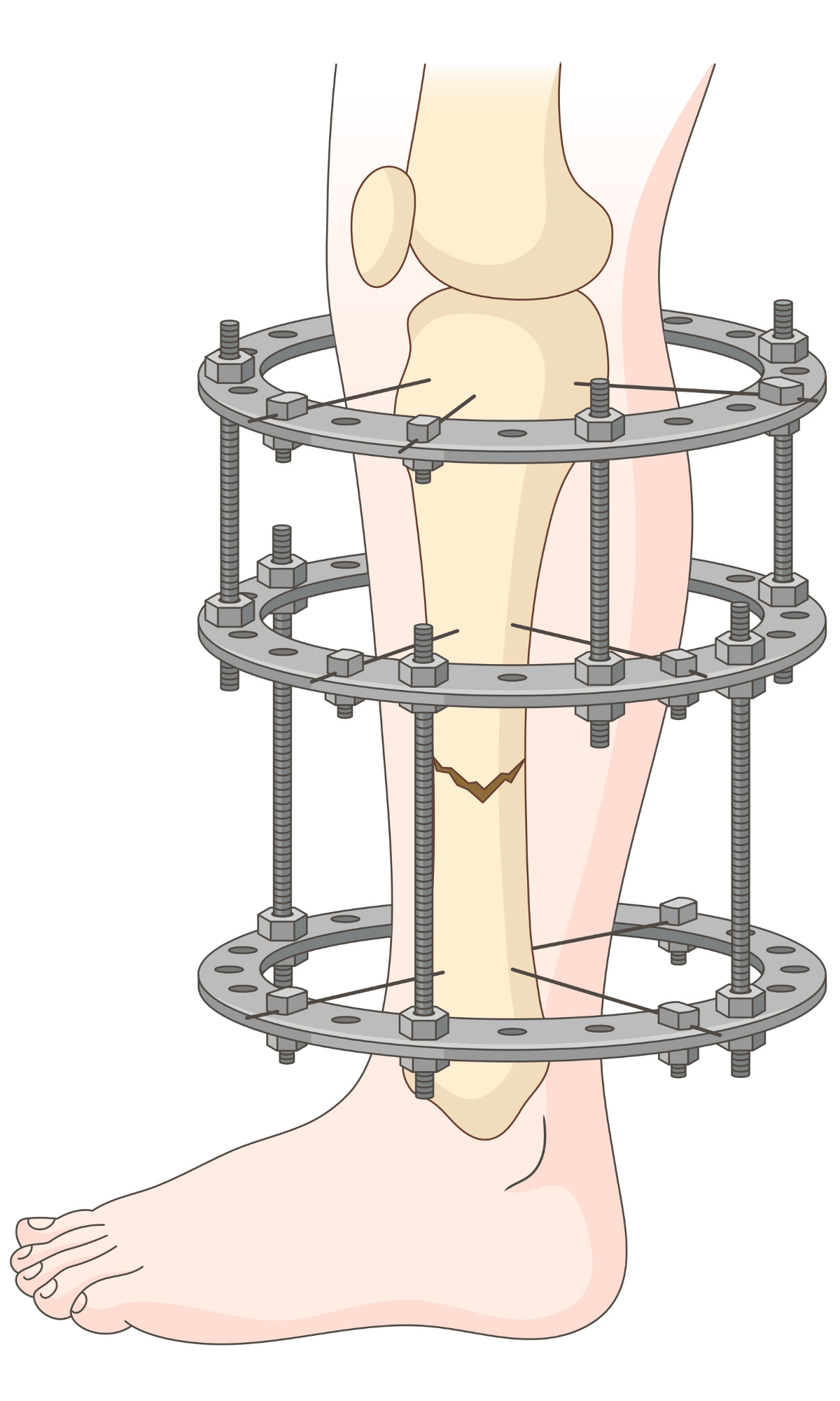 A diagram is seen showing the Ilizarov apparatus - a circular, external frame used in orthopedics to fix, lengthen, or reshape bones and correct deformities.